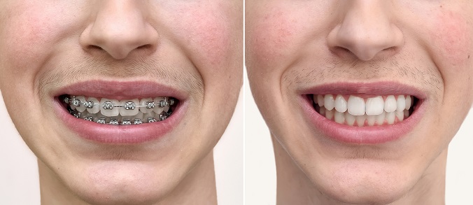 teeth before and after braces 